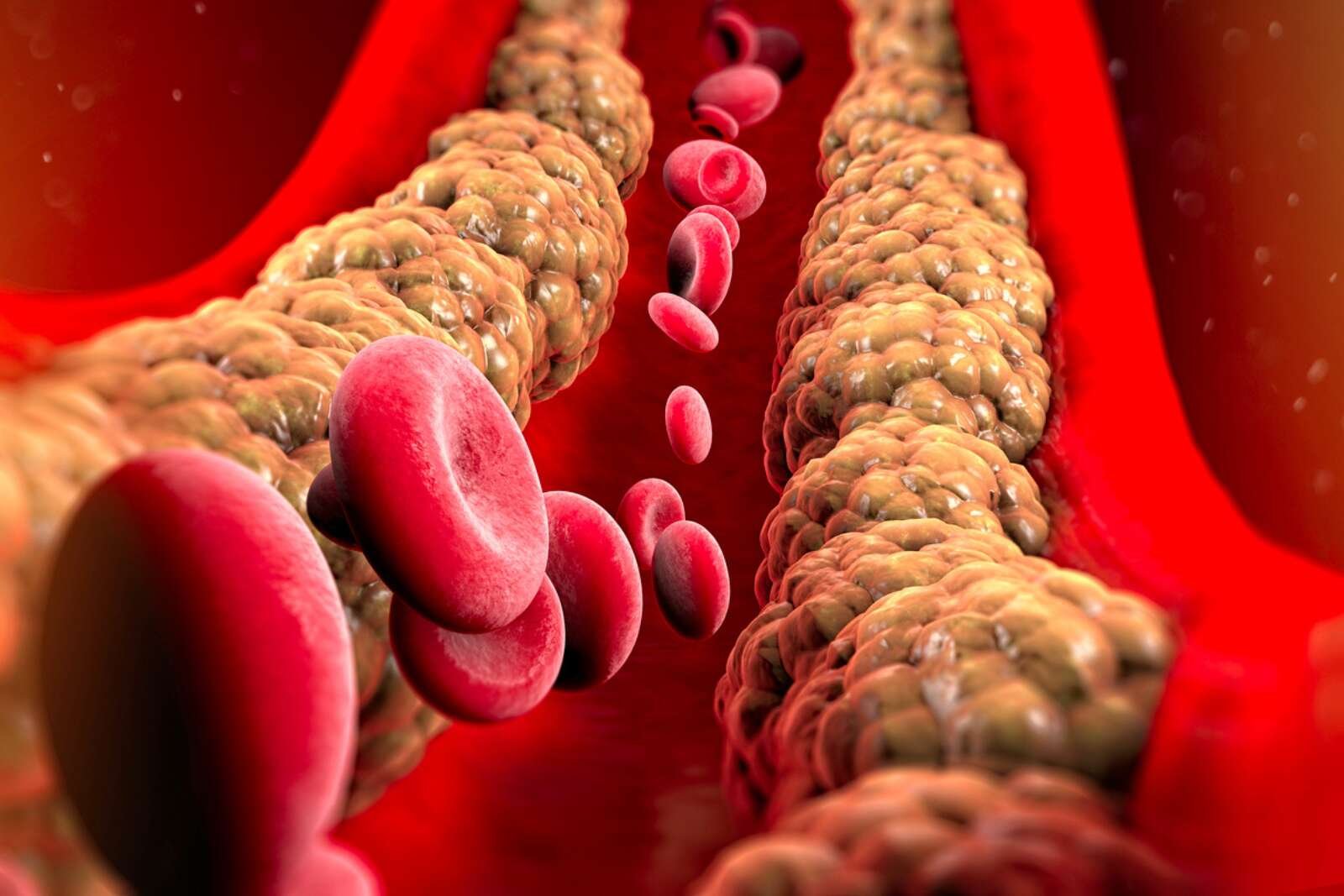 2384ddc07d_50228748_symptomes-cholesterol