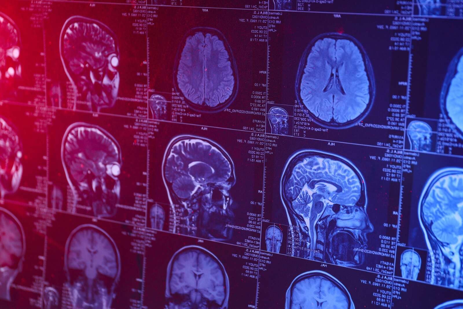 ca76b17bc2_50230009_cerveau-alzheimer-jeune-adulte