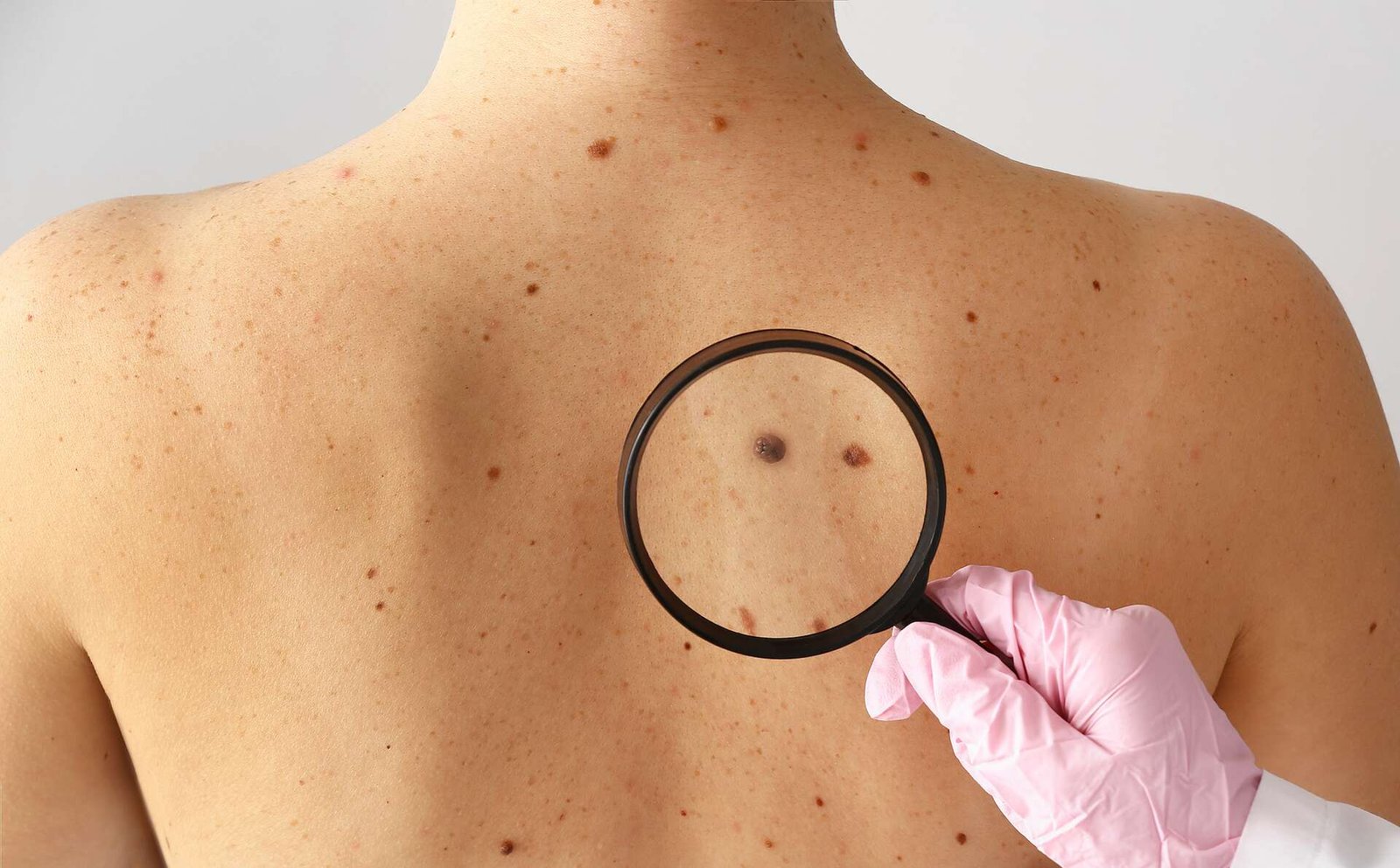 09ee04ded6_50237387_dermatologie-cancer-peau-soleil